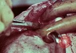 Image of wounded soldier European Theater, 1945, second 51 stock footage video 65675077545