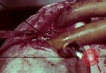 Image of wounded soldier European Theater, 1945, second 52 stock footage video 65675077545