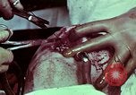Image of wounded soldier European Theater, 1945, second 53 stock footage video 65675077545