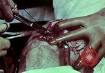 Image of wounded soldier European Theater, 1945, second 54 stock footage video 65675077545