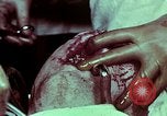 Image of wounded soldier European Theater, 1945, second 55 stock footage video 65675077545
