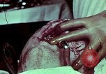 Image of wounded soldier European Theater, 1945, second 56 stock footage video 65675077545