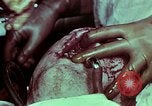 Image of wounded soldier European Theater, 1945, second 58 stock footage video 65675077545