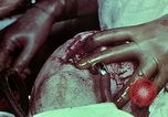 Image of wounded soldier European Theater, 1945, second 59 stock footage video 65675077545