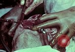 Image of wounded soldier European Theater, 1945, second 61 stock footage video 65675077545