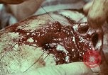 Image of wounded soldier European Theater, 1945, second 5 stock footage video 65675077546