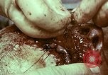 Image of wounded soldier European Theater, 1945, second 7 stock footage video 65675077546