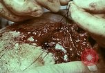 Image of wounded soldier European Theater, 1945, second 8 stock footage video 65675077546