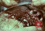 Image of wounded soldier European Theater, 1945, second 9 stock footage video 65675077546