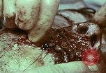 Image of wounded soldier European Theater, 1945, second 11 stock footage video 65675077546