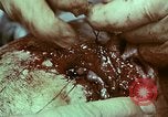Image of wounded soldier European Theater, 1945, second 12 stock footage video 65675077546