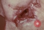 Image of wounded soldier European Theater, 1945, second 18 stock footage video 65675077546