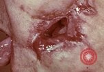 Image of wounded soldier European Theater, 1945, second 19 stock footage video 65675077546