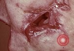 Image of wounded soldier European Theater, 1945, second 20 stock footage video 65675077546