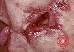 Image of wounded soldier European Theater, 1945, second 21 stock footage video 65675077546