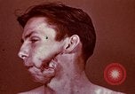 Image of wounded soldier European Theater, 1945, second 25 stock footage video 65675077546