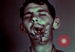 Image of wounded soldier European Theater, 1945, second 52 stock footage video 65675077546