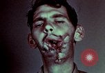 Image of wounded soldier European Theater, 1945, second 53 stock footage video 65675077546