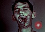 Image of wounded soldier European Theater, 1945, second 54 stock footage video 65675077546
