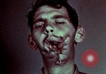 Image of wounded soldier European Theater, 1945, second 55 stock footage video 65675077546
