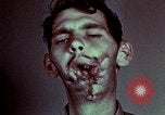 Image of wounded soldier European Theater, 1945, second 56 stock footage video 65675077546