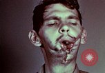 Image of wounded soldier European Theater, 1945, second 58 stock footage video 65675077546