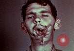 Image of wounded soldier European Theater, 1945, second 59 stock footage video 65675077546
