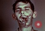 Image of wounded soldier European Theater, 1945, second 60 stock footage video 65675077546