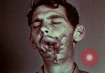 Image of wounded soldier European Theater, 1945, second 61 stock footage video 65675077546