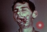 Image of wounded soldier European Theater, 1945, second 62 stock footage video 65675077546