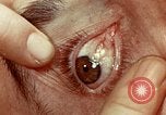 Image of eye surgery United States USA, 1945, second 43 stock footage video 65675077558