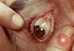 Image of eye surgery United States USA, 1945, second 44 stock footage video 65675077558