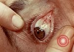 Image of eye surgery United States USA, 1945, second 45 stock footage video 65675077558
