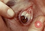 Image of eye surgery United States USA, 1945, second 46 stock footage video 65675077558