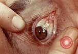 Image of eye surgery United States USA, 1945, second 50 stock footage video 65675077558