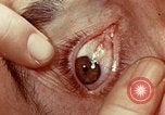 Image of eye surgery United States USA, 1945, second 52 stock footage video 65675077558