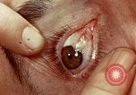 Image of eye surgery United States USA, 1945, second 54 stock footage video 65675077558