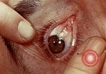 Image of eye surgery United States USA, 1945, second 55 stock footage video 65675077558