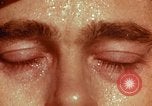 Image of eye surgery United States USA, 1945, second 7 stock footage video 65675077559