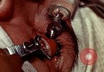 Image of eye surgery United States USA, 1945, second 60 stock footage video 65675077559