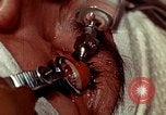 Image of eye surgery United States USA, 1945, second 61 stock footage video 65675077559