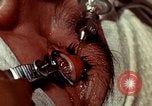 Image of eye surgery United States USA, 1945, second 62 stock footage video 65675077559