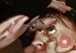 Image of eye surgery United States USA, 1945, second 25 stock footage video 65675077560