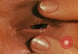 Image of eye surgery United States USA, 1945, second 36 stock footage video 65675077560