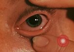 Image of eye surgery United States USA, 1945, second 37 stock footage video 65675077560