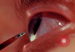 Image of eye surgery United States USA, 1945, second 47 stock footage video 65675077560
