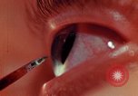 Image of eye surgery United States USA, 1945, second 48 stock footage video 65675077560