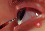 Image of eye surgery United States USA, 1945, second 49 stock footage video 65675077560