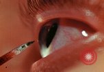 Image of eye surgery United States USA, 1945, second 50 stock footage video 65675077560