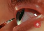 Image of eye surgery United States USA, 1945, second 51 stock footage video 65675077560